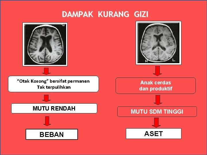 DAMPAK KURANG GIZI “Otak Kosong” bersifat permanen Tak terpulihkan MUTU RENDAH BEBAN Anak cerdas DAMPAK KURANG GIZI “Otak Kosong” bersifat permanen Tak terpulihkan MUTU RENDAH BEBAN Anak cerdas