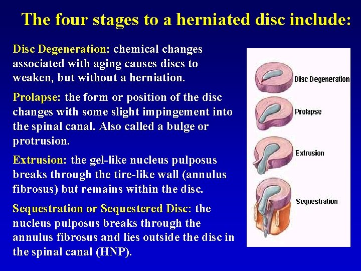 The four stages to a herniated disc include: Disc Degeneration: chemical changes associated with