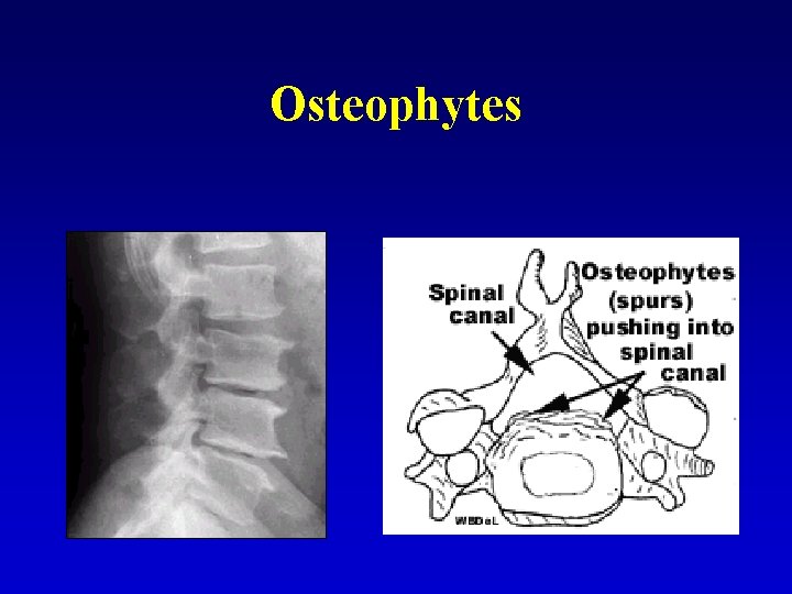 Osteophytes 