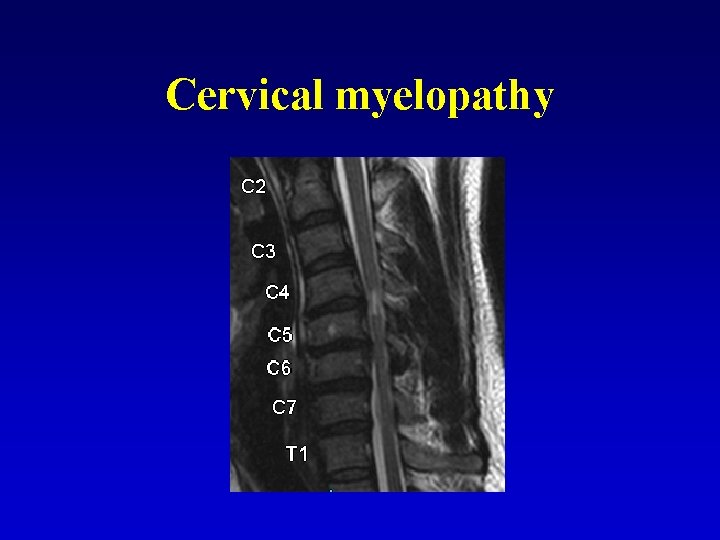 Cervical myelopathy 