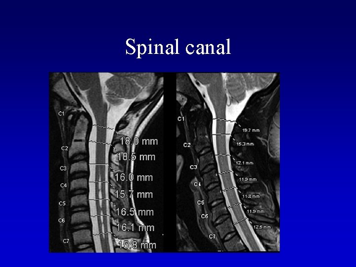 Spinal canal 