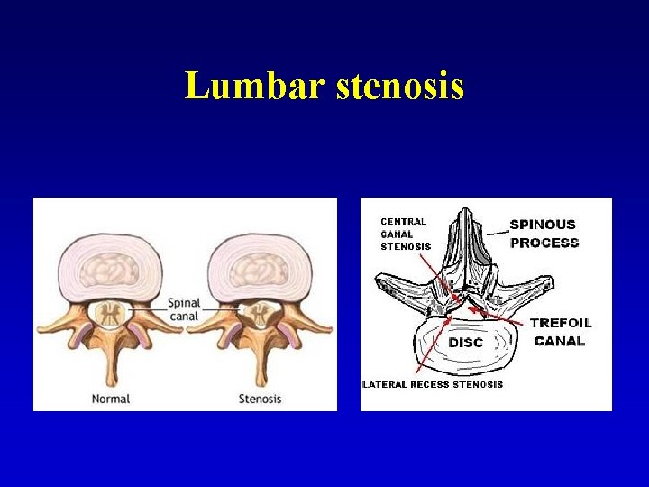 Lumbar stenosis 