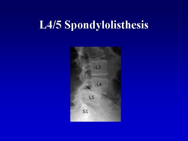 L 4/5 Spondylolisthesis 