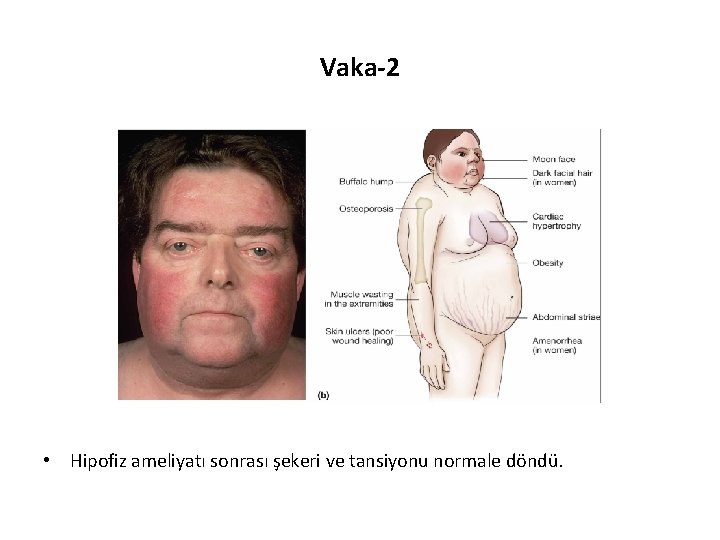 Vaka-2 • Hipofiz ameliyatı sonrası şekeri ve tansiyonu normale döndü. 