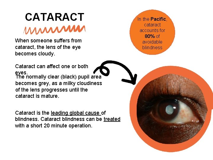CATARACT When someone suffers from cataract, the lens of the eye becomes cloudy. Cataract