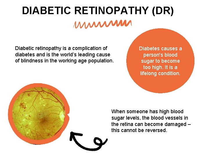 DIABETIC RETINOPATHY (DR) Diabetic retinopathy is a complication of diabetes and is the world’s