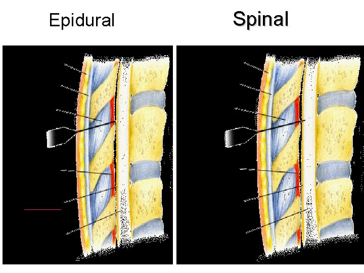 Epidural Spinal 12 