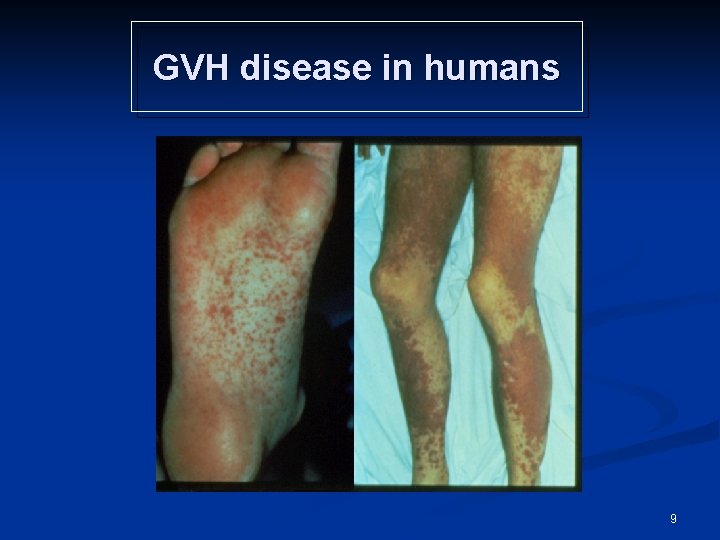 GVH disease in humans 9 