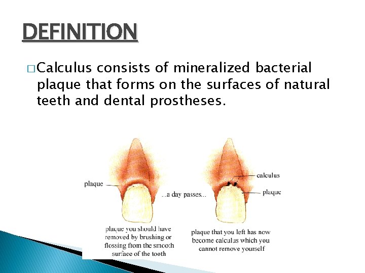 DEFINITION � Calculus consists of mineralized bacterial plaque that forms on the surfaces of DEFINITION � Calculus consists of mineralized bacterial plaque that forms on the surfaces of