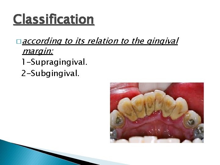 Classification � according margin: to its relation to the gingival 1 -Supragingival. 2 -Subgingival.