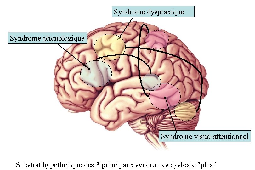 Syndrome dyspraxique Syndrome phonologique Syndrome visuo-attentionnel Substrat hypothétique des 3 principaux syndromes dyslexie "plus"