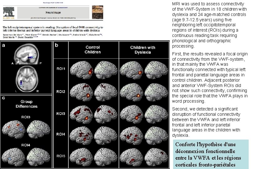 MRI was used to assess connectivity of the VWF-System in 18 children with dyslexia