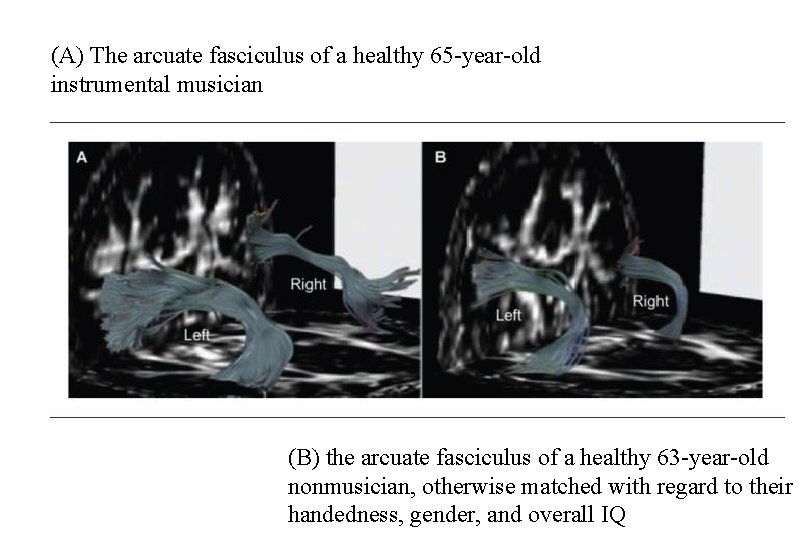 (A) The arcuate fasciculus of a healthy 65 -year-old instrumental musician (B) the arcuate