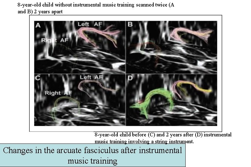 8 -year-old child without instrumental music training scanned twice (A and B) 2 years