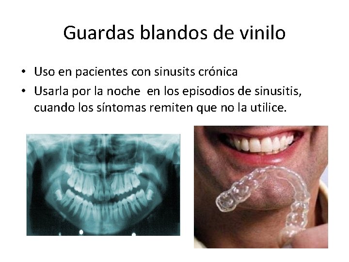 Guardas blandos de vinilo • Uso en pacientes con sinusits crónica • Usarla por