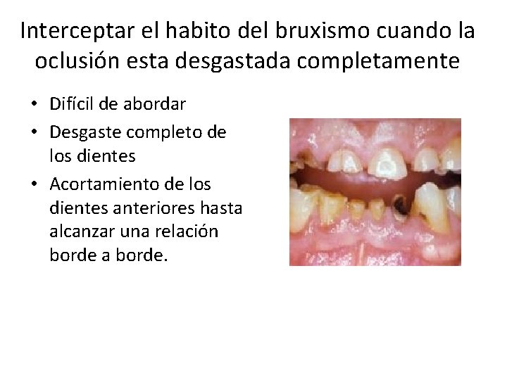 Interceptar el habito del bruxismo cuando la oclusión esta desgastada completamente • Difícil de