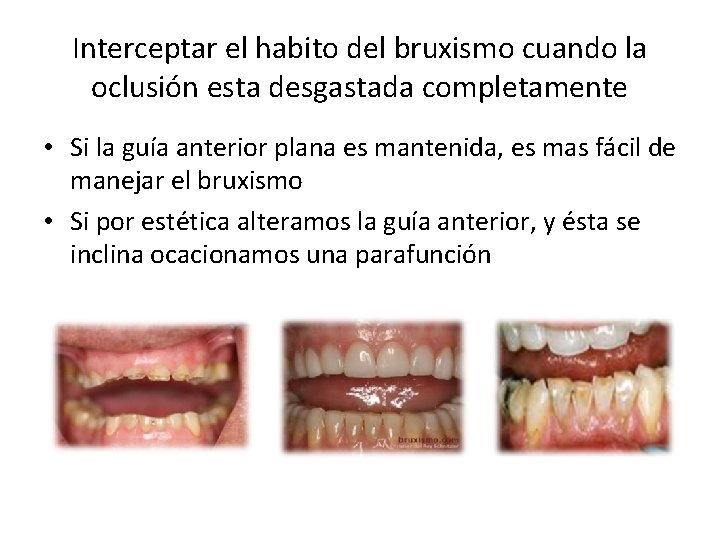 Interceptar el habito del bruxismo cuando la oclusión esta desgastada completamente • Si la