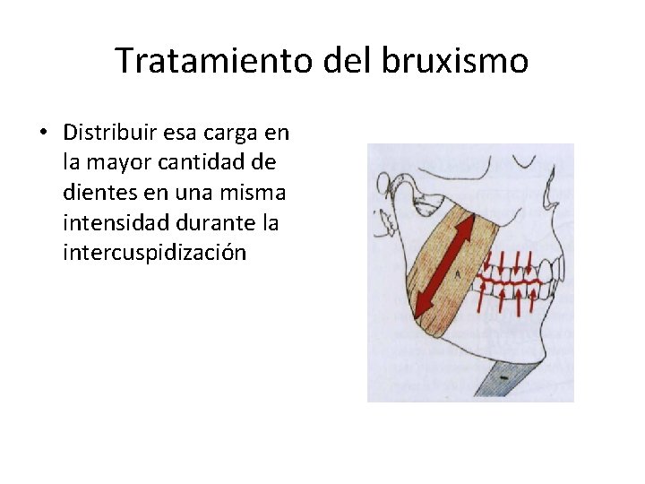 Tratamiento del bruxismo • Distribuir esa carga en la mayor cantidad de dientes en