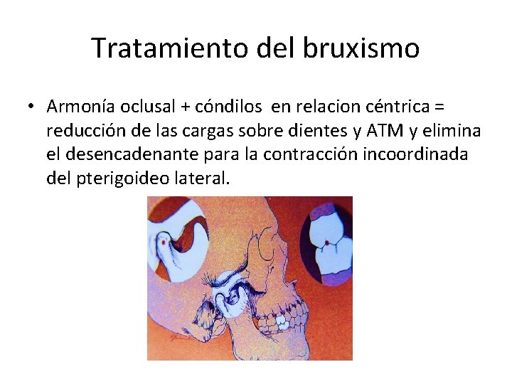 Tratamiento del bruxismo • Armonía oclusal + cóndilos en relacion céntrica = reducción de