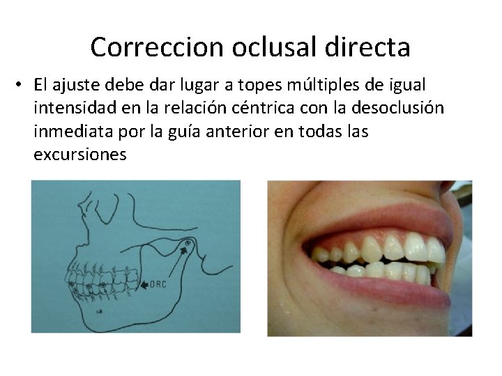 Correccion oclusal directa • El ajuste debe dar lugar a topes múltiples de igual