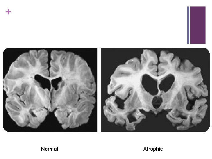 + Normal Atrophic 