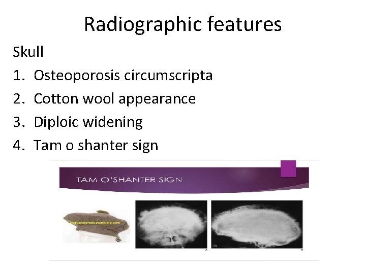 Radiographic features Skull 1. Osteoporosis circumscripta 2. Cotton wool appearance 3. Diploic widening 4.