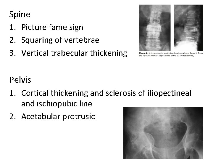 Spine 1. Picture fame sign 2. Squaring of vertebrae 3. Vertical trabecular thickening Pelvis