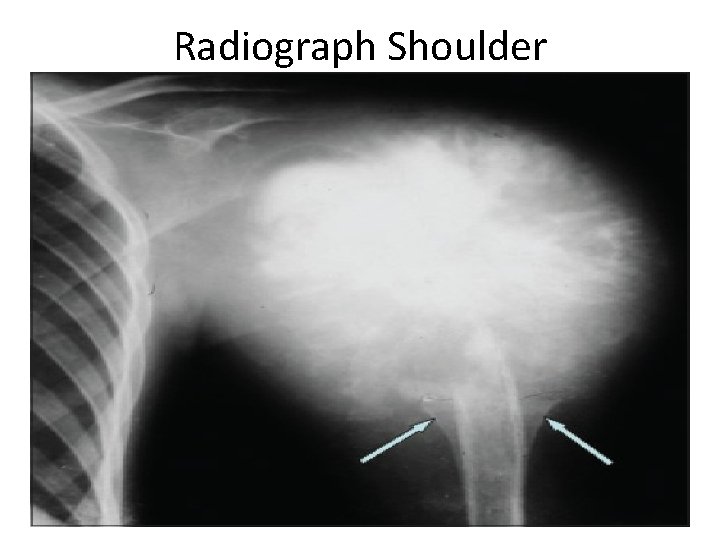 Radiograph Shoulder 