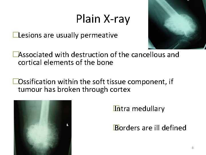 Plain X-ray �Lesions are usually permeative �Associated with destruction of the cancellous and cortical