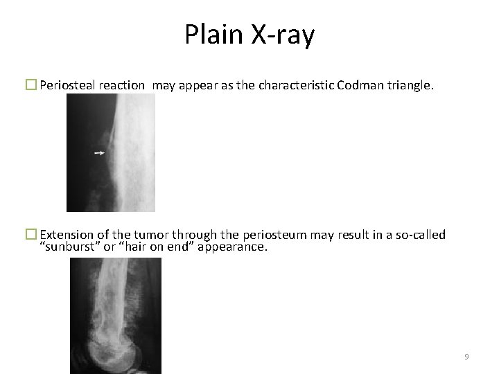 Plain X-ray � Periosteal reaction may appear as the characteristic Codman triangle. � Extension