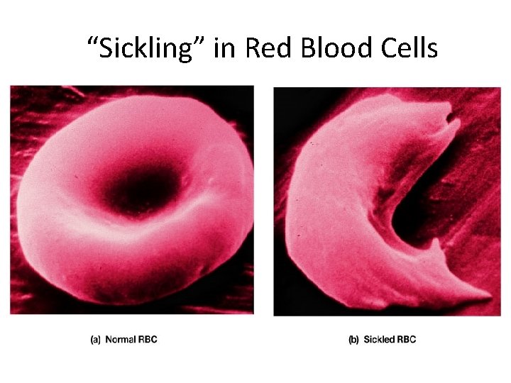 “Sickling” in Red Blood Cells 