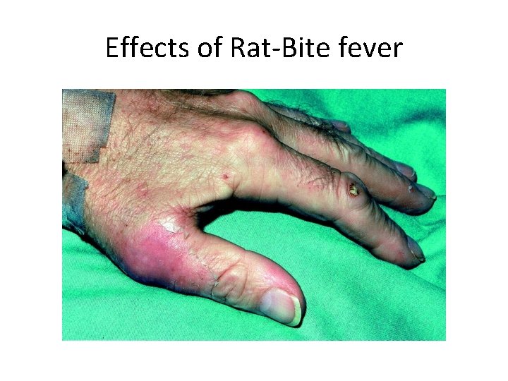 Effects of Rat-Bite fever 