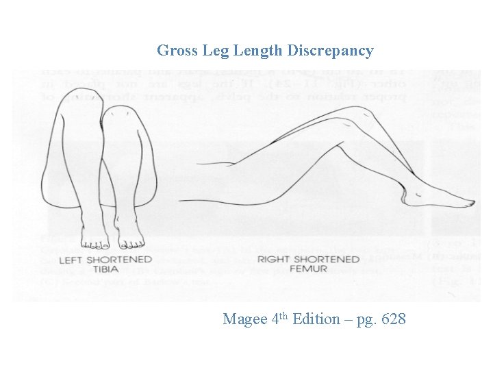 Gross Leg Length Discrepancy Magee 4 th Edition – pg. 628 