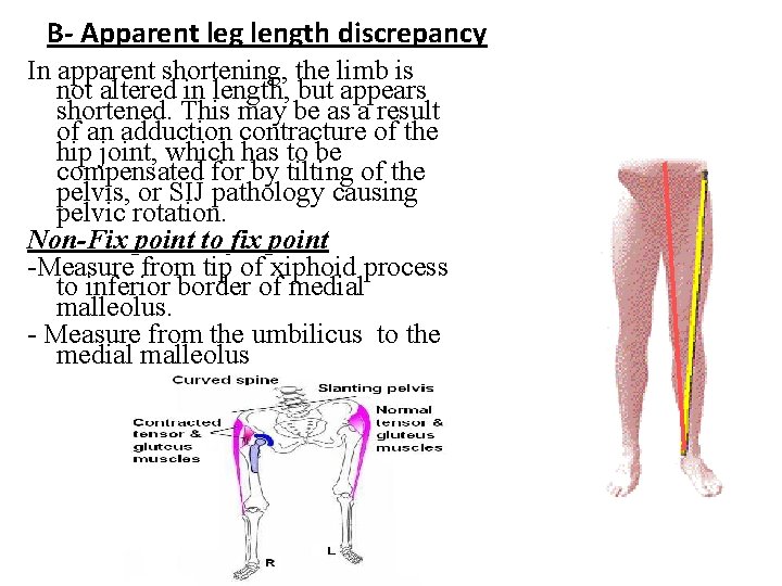 B- Apparent leg length discrepancy In apparent shortening, the limb is not altered in