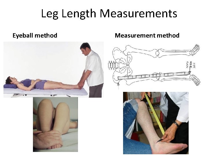 Leg Length Measurements Eyeball method Measurement method 