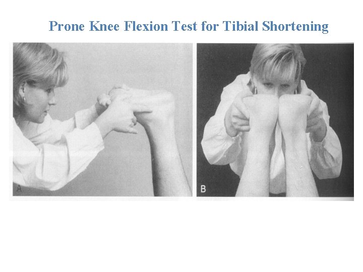 Prone Knee Flexion Test for Tibial Shortening 