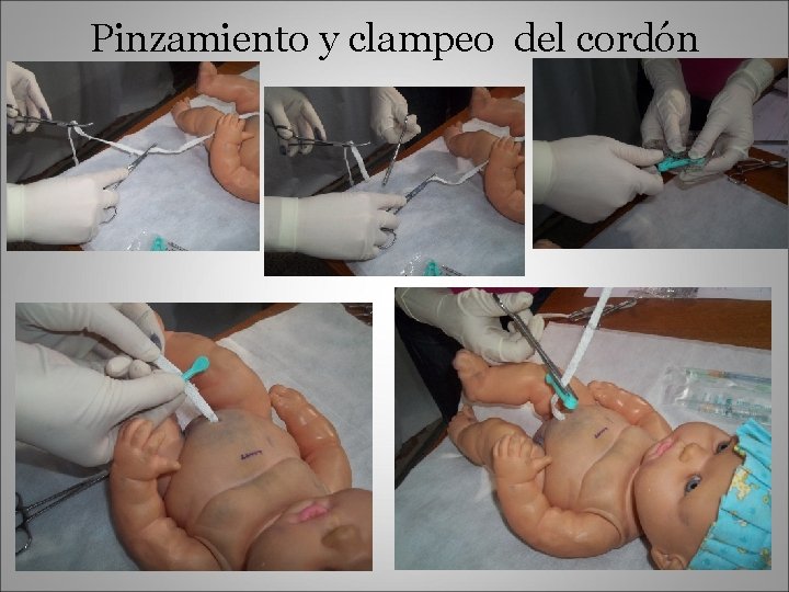 Pinzamiento y clampeo del cordón 