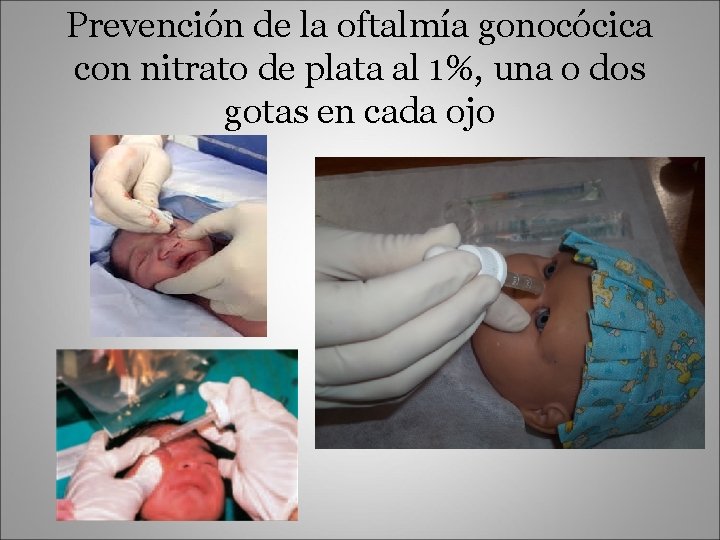 Prevención de la oftalmía gonocócica con nitrato de plata al 1%, una o dos