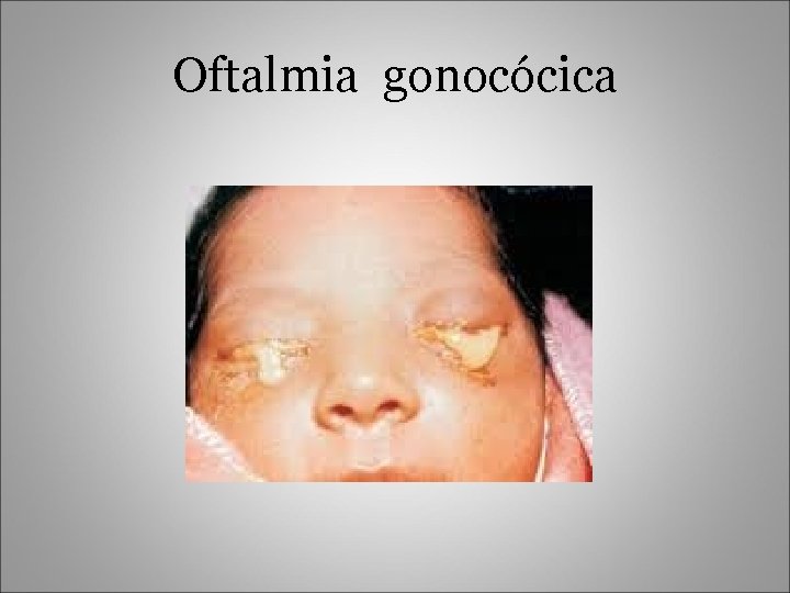 Oftalmia gonocócica 