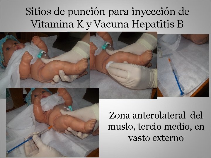Sitios de punción para inyección de Vitamina K y Vacuna Hepatitis B Zona anterolateral