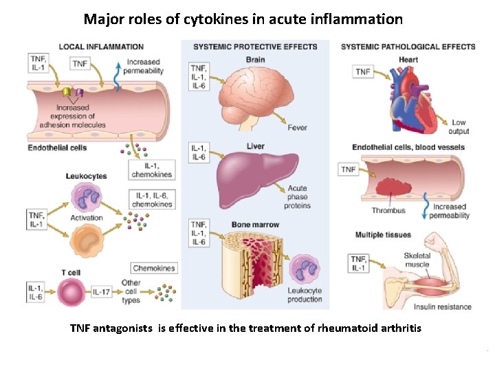 Major roles of cytokines in acute inflammation TNF antagonists is effective in the treatment