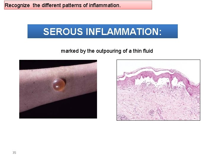 Recognize the different patterns of inflammation. SEROUS INFLAMMATION: marked by the outpouring of a