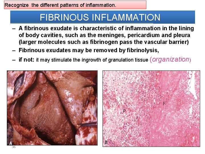 Recognize the different patterns of inflammation. FIBRINOUS INFLAMMATION – A fibrinous exudate is characteristic