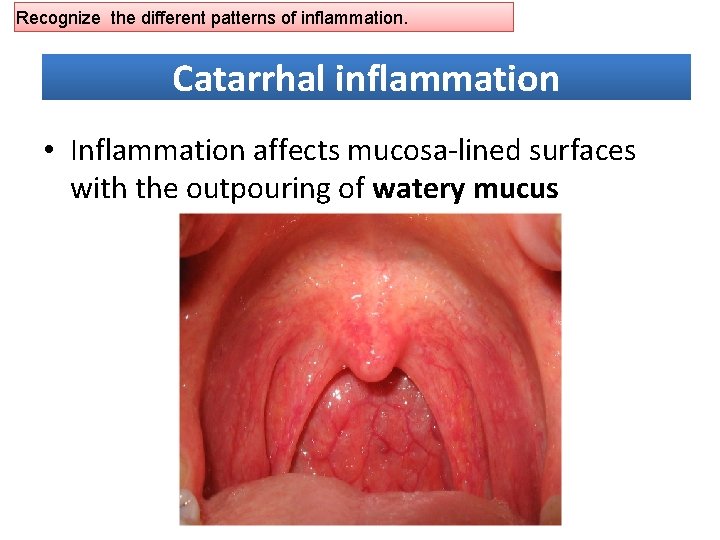 Recognize the different patterns of inflammation. Catarrhal inflammation • Inflammation affects mucosa-lined surfaces with