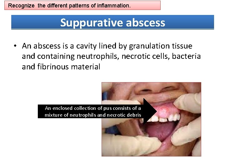Recognize the different patterns of inflammation. Suppurative abscess • An abscess is a cavity