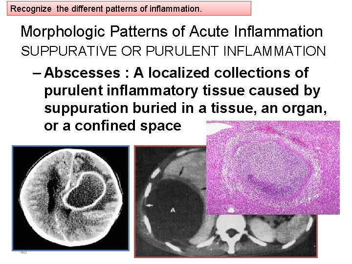 Recognize the different patterns of inflammation. Morphologic Patterns of Acute Inflammation SUPPURATIVE OR PURULENT