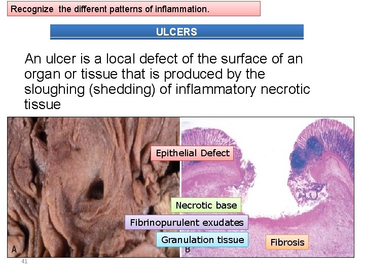 Recognize the different patterns of inflammation. ULCERS An ulcer is a local defect of