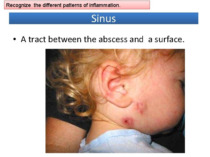 Recognize the different patterns of inflammation. Sinus • A tract between the abscess and