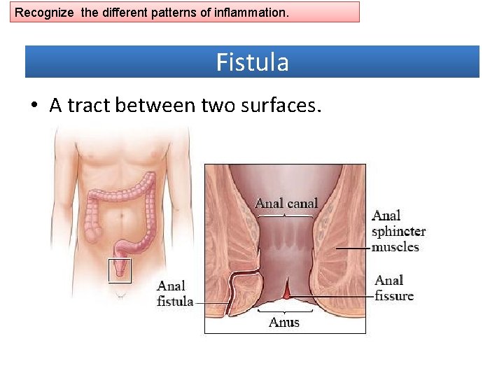 Recognize the different patterns of inflammation. Fistula • A tract between two surfaces. 