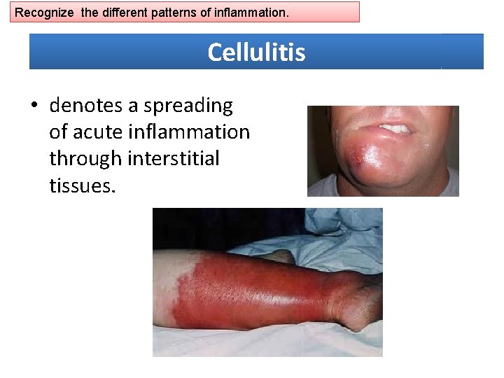Recognize the different patterns of inflammation. Cellulitis • denotes a spreading of acute inflammation